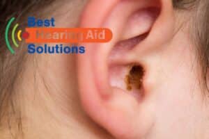 Ear with earwax in it.